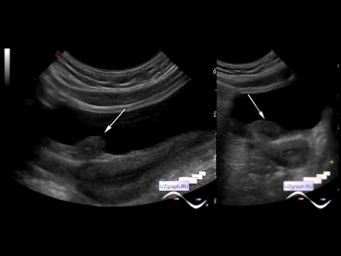 УЗИ малого таза - Следствие ведут &quot;колобки&quot; однорогая матка с рудиментарным рогом у ребенка 